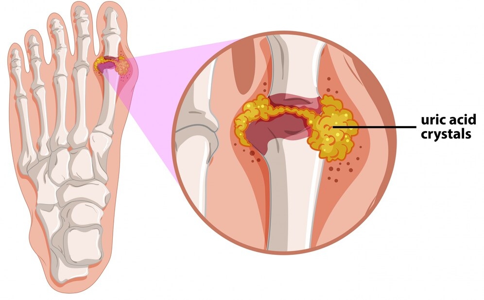 A medical diagram illustrating gout in the human foot