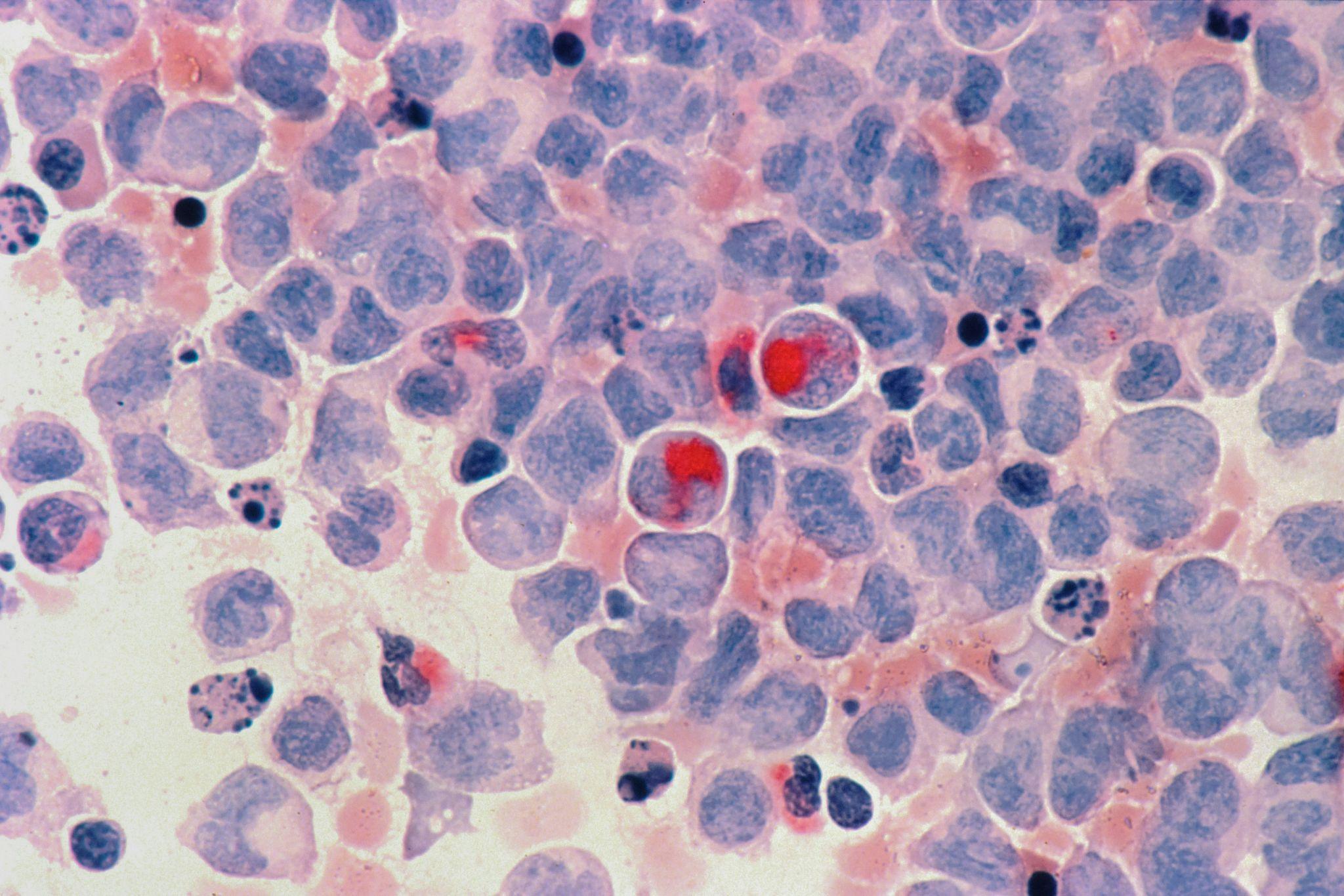 Microscopic view of leukemia cells.