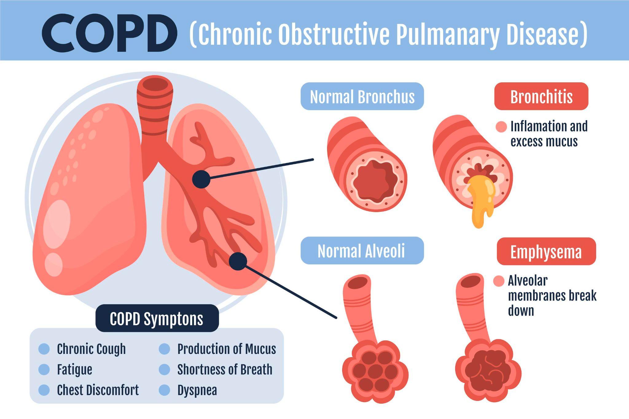 An infographic explaining COPD (Chronic Obstructive Pulmonary Disease)