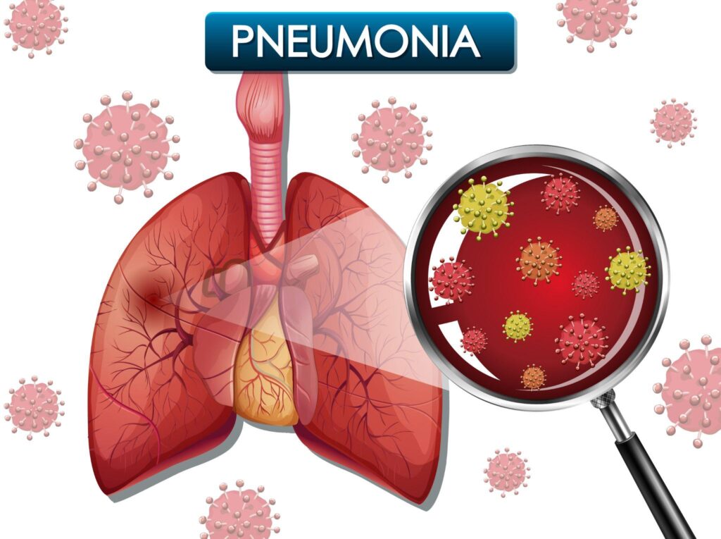 An illustration of human lungs with a magnified view of pneumonia-causing viruses.