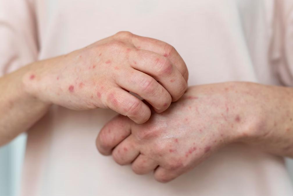 A close-up of hands with a skin infection