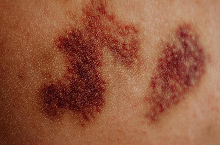 A close-up of a skin infection.