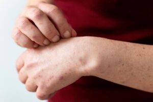 A close-up of hands with red spots.