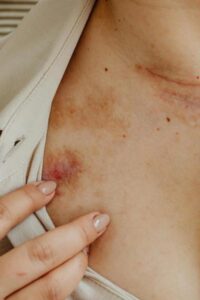 A woman with a contagious skin infection. 