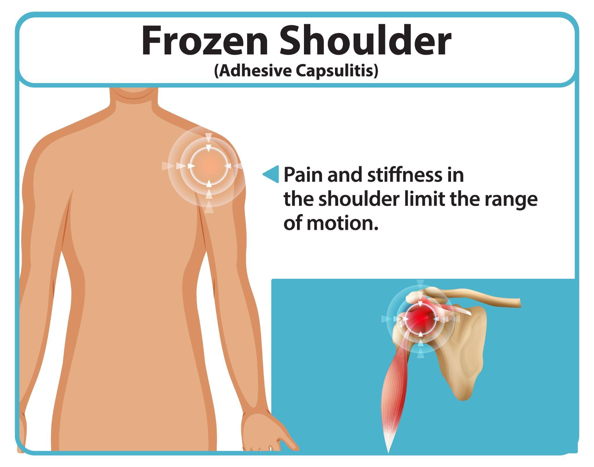 Infographic illustrating frozen shoulder symptoms