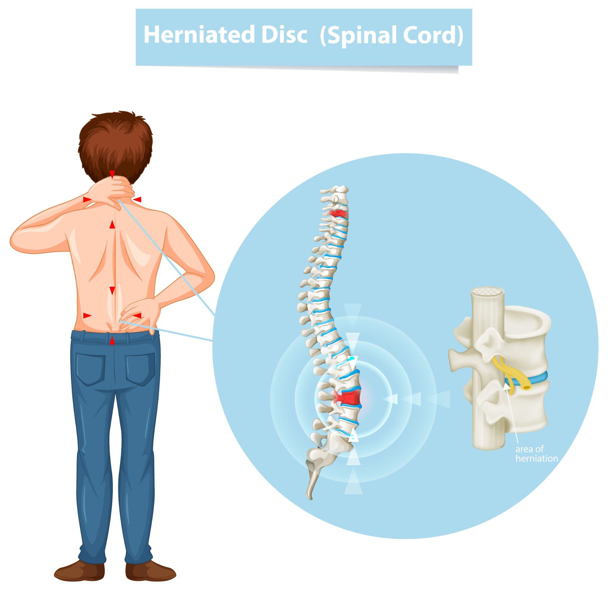 Medical illustration of a herniated disc