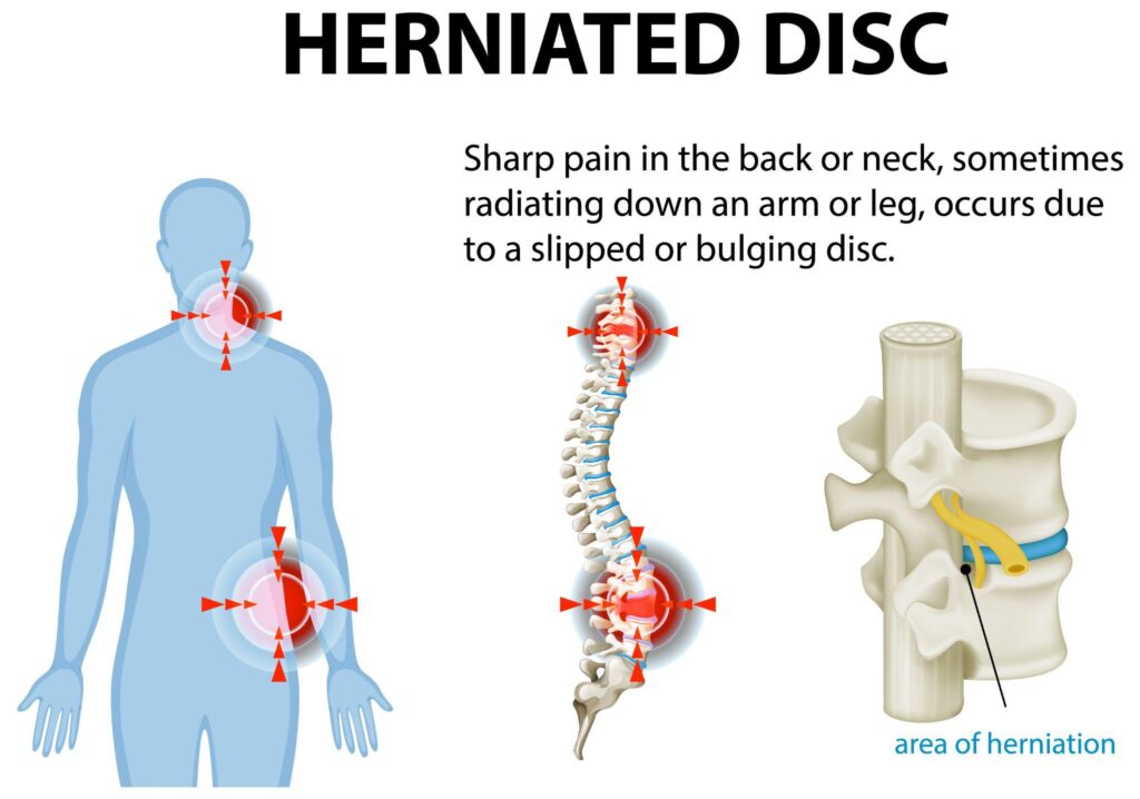 Infographic illustrating the structure of a herniated disc