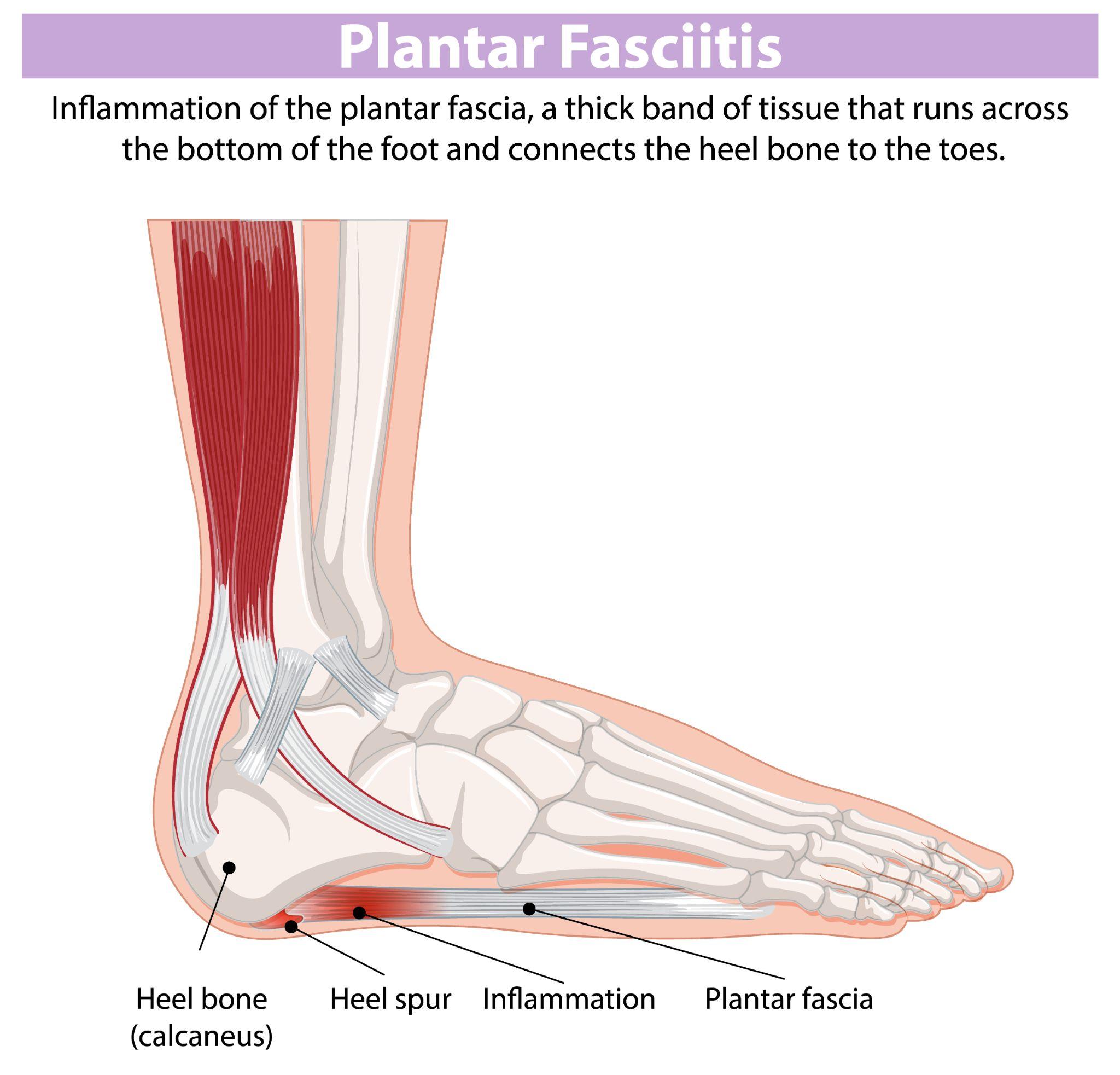 Plantar fasciitis infographic highlighting heel pain