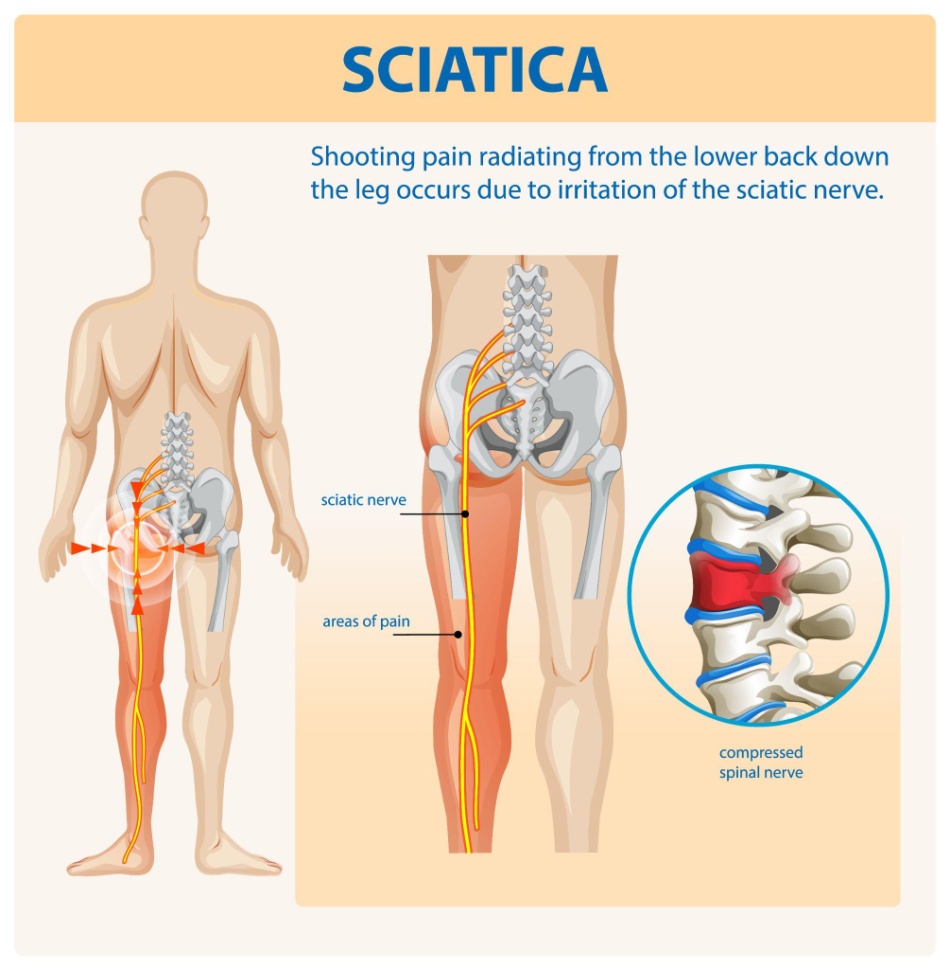 Diagram showing the sciatic nerve and areas affected by sciatica pain