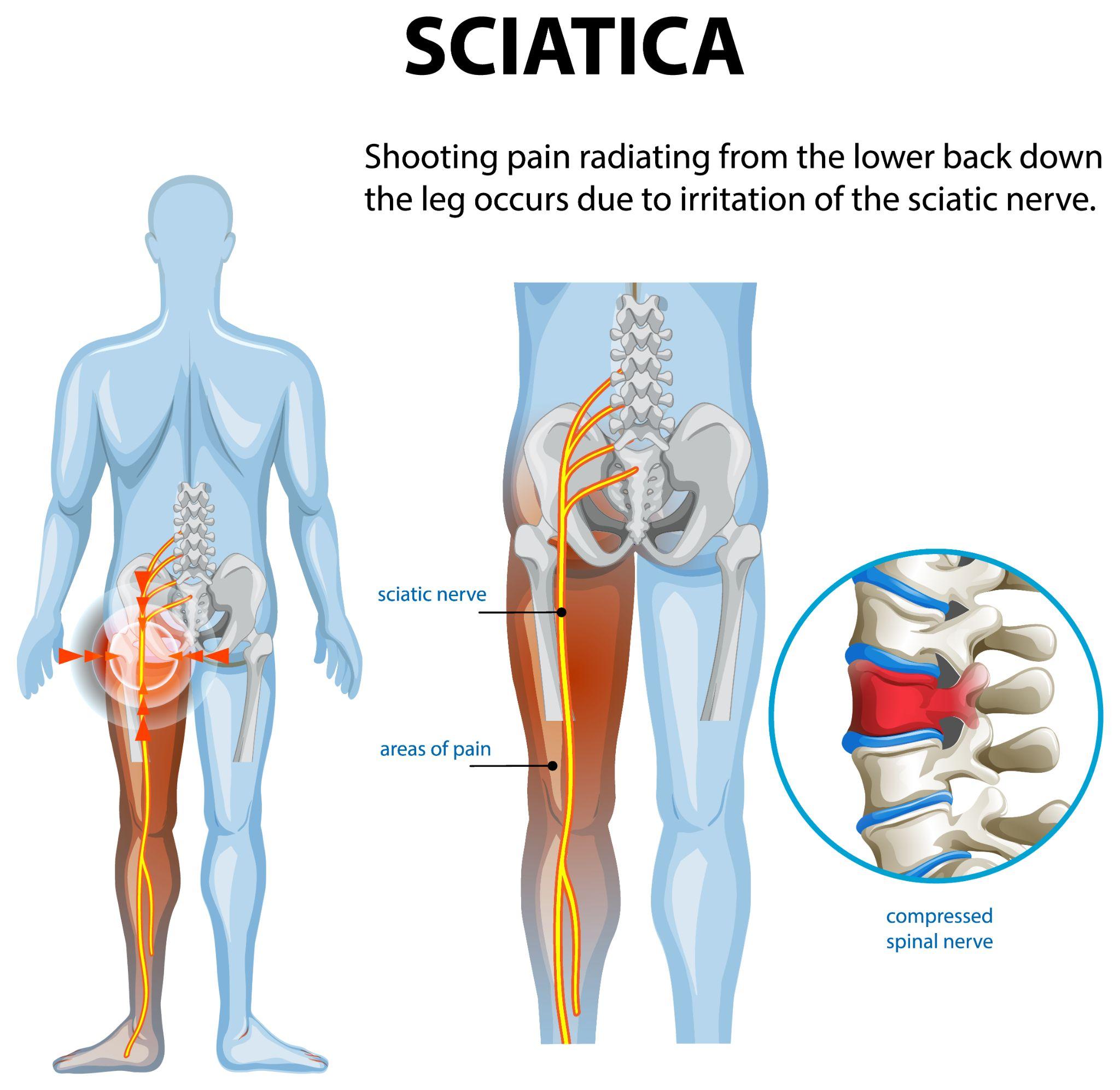 Sciatica nerve pain infographic showing pain path