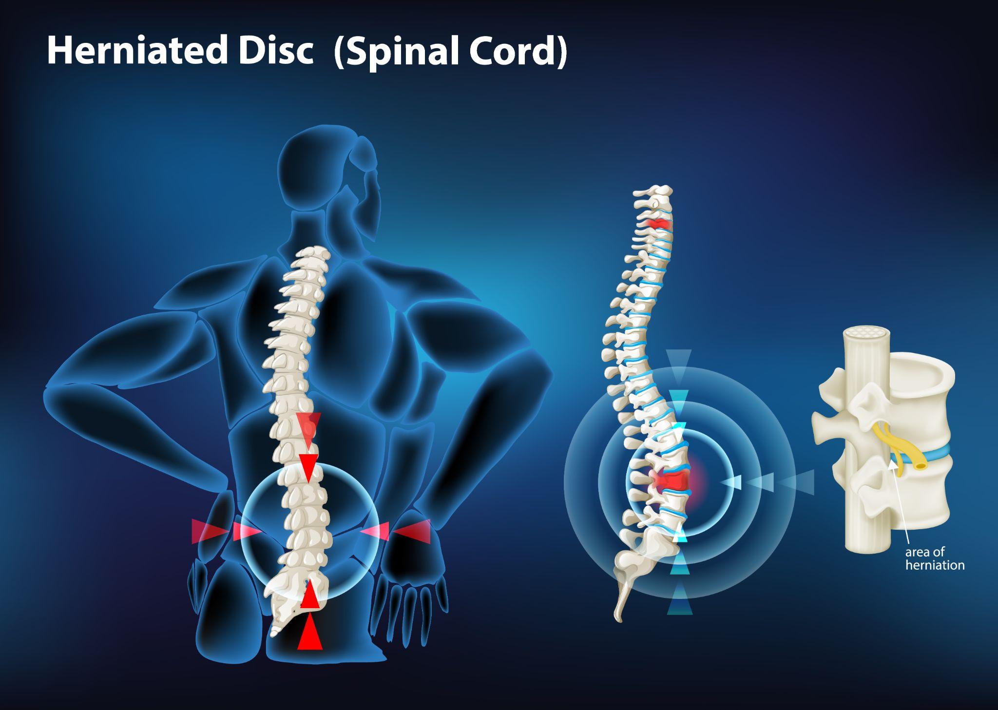 Medical diagram showing the spinal cord and the location of a herniated disc