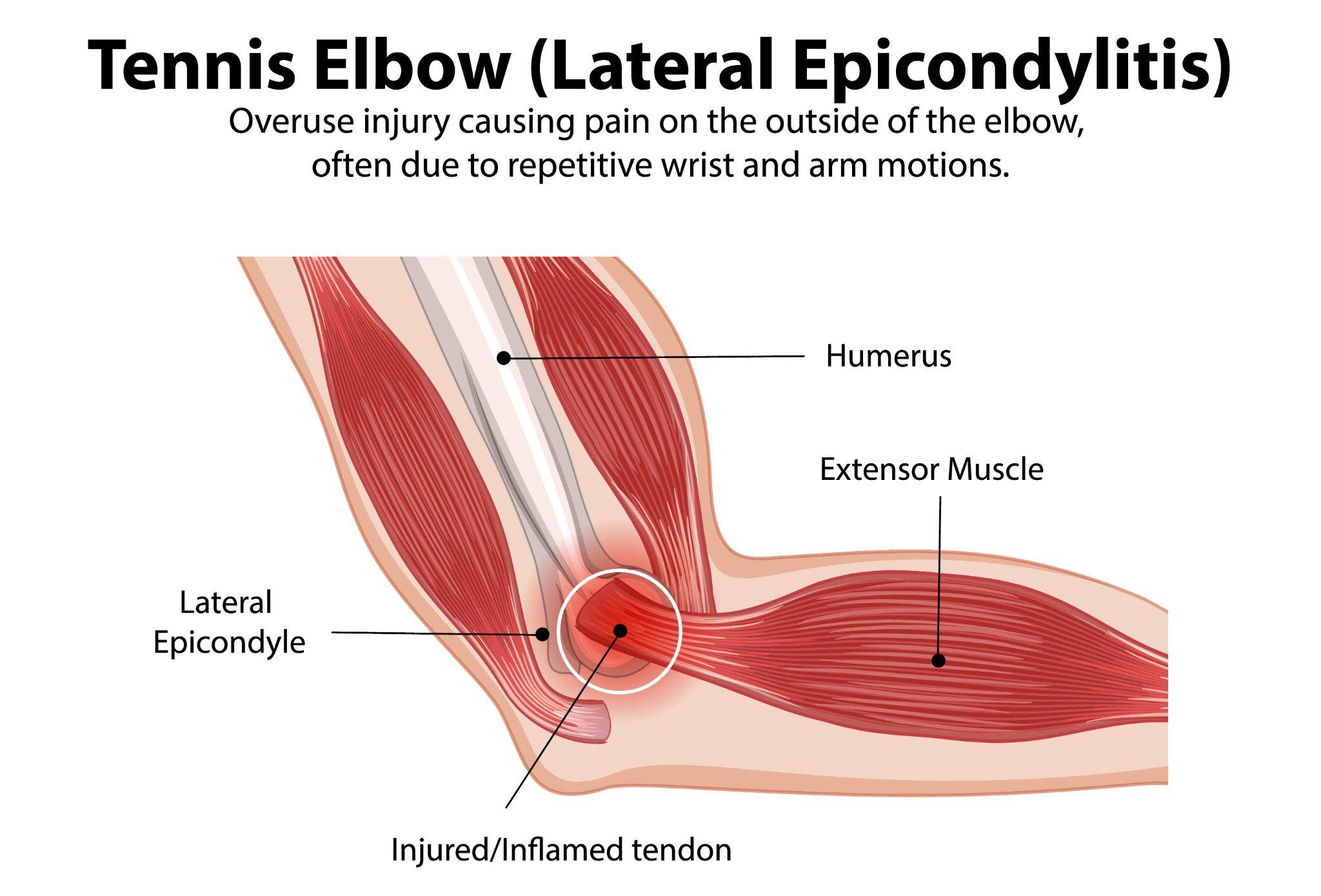 A tennis elbow infographic 