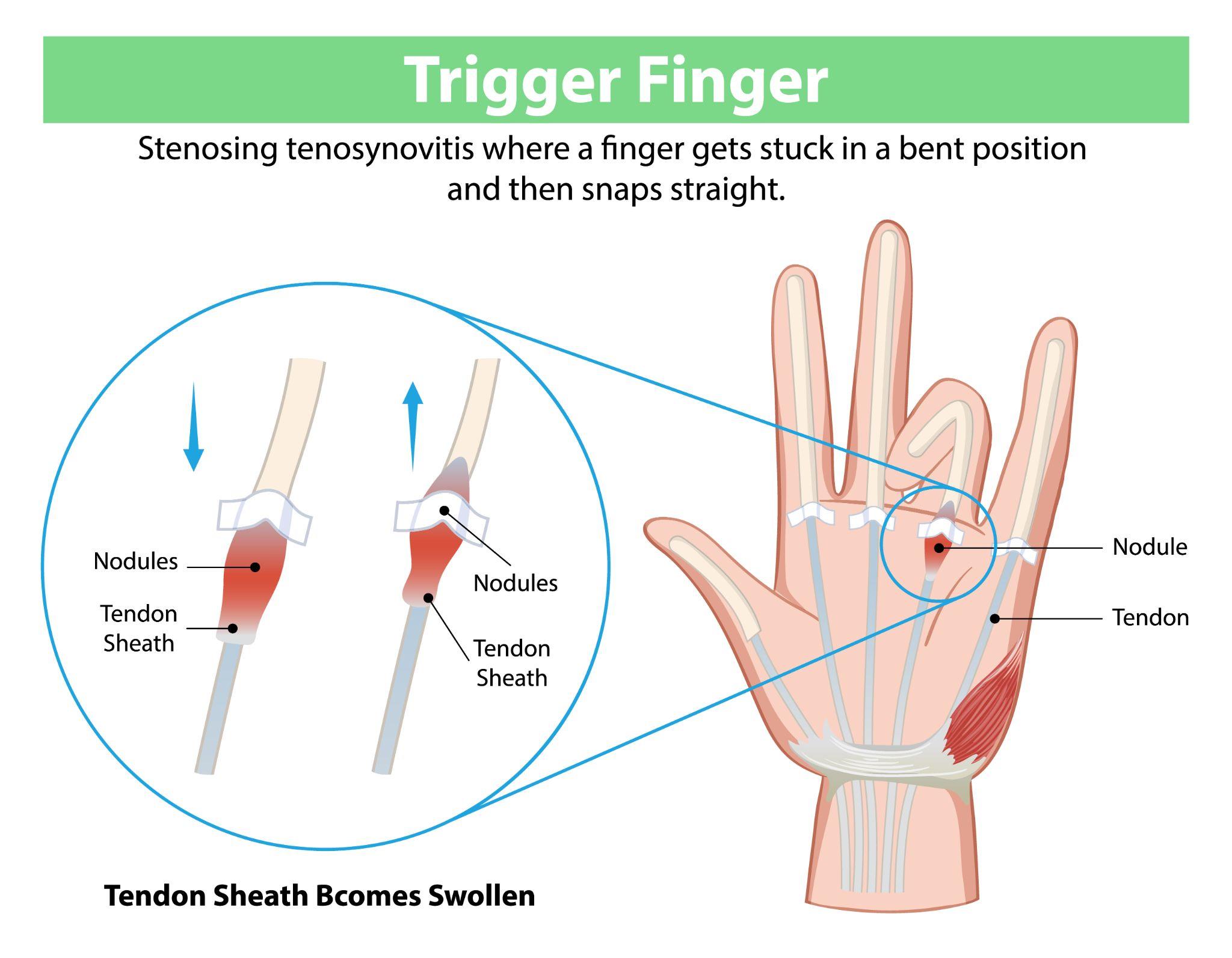Trigger finger infographic with finger motion illustration