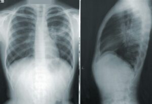 Two chest X-ray images showing pneumonia in the lungs